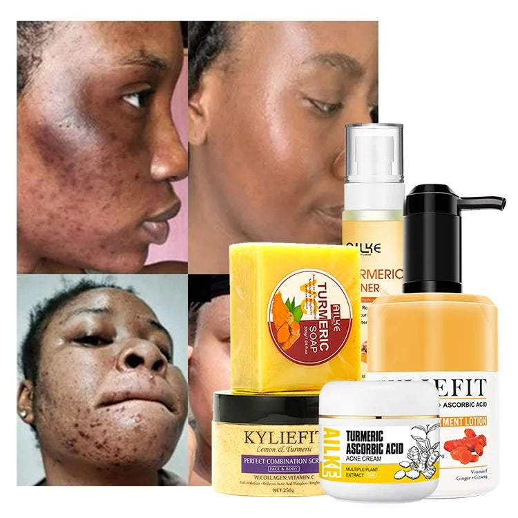 Ailke OEM Beauty Product Tumeric Skin Care Whitening Cream Set Anti Acne Brightening Skin Care Set