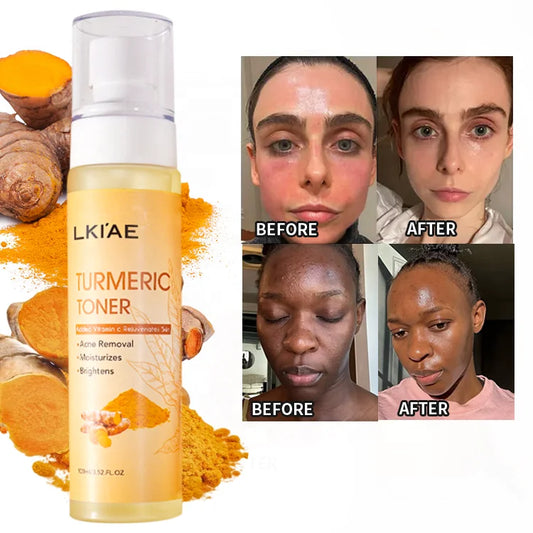 Ailke (New) Glowing Turmeric and Vitamine C Spray Acne Prone Moisturizing Tumeric Face Cosmetics Skin Toner for Oily